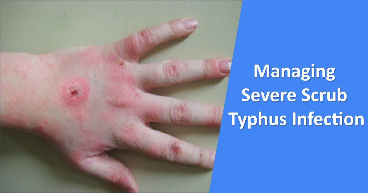 Diagnostic Challenges In Managing Severe Scrub Typhus Infection