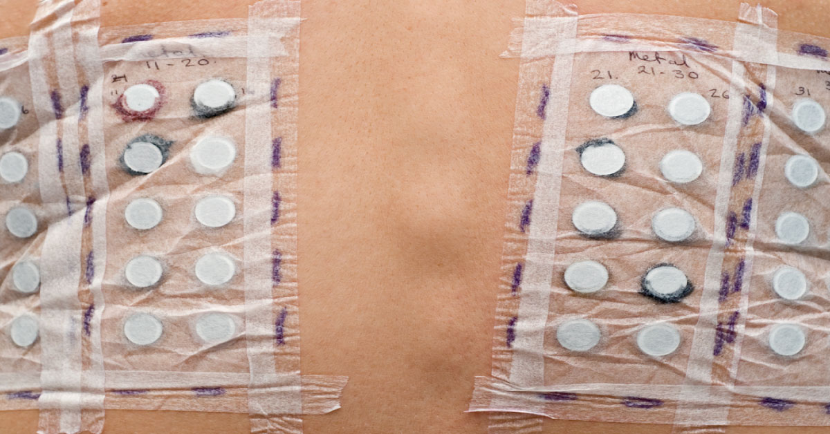 Skin Testing For Carboplatin Induced Hypersensitivity