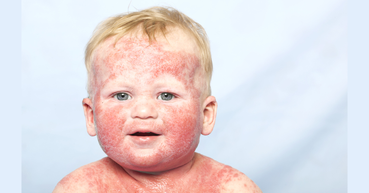 Atopic Eczema In Children: National Institute for Health and Care Excellence