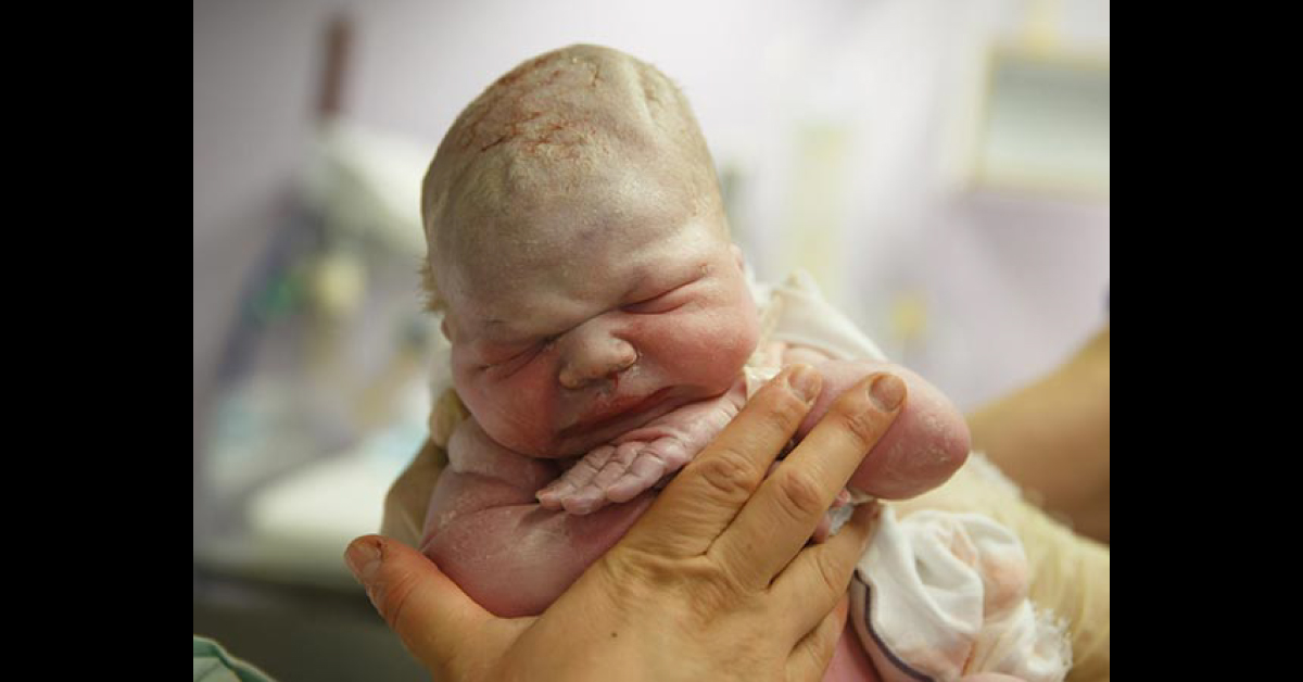 Stillbirths, A Harsh Medical Reality
