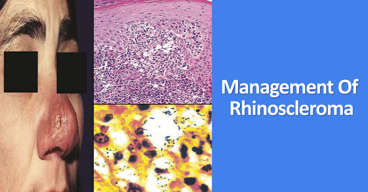 Practice Essentials For The Management Of Rhinoscleroma