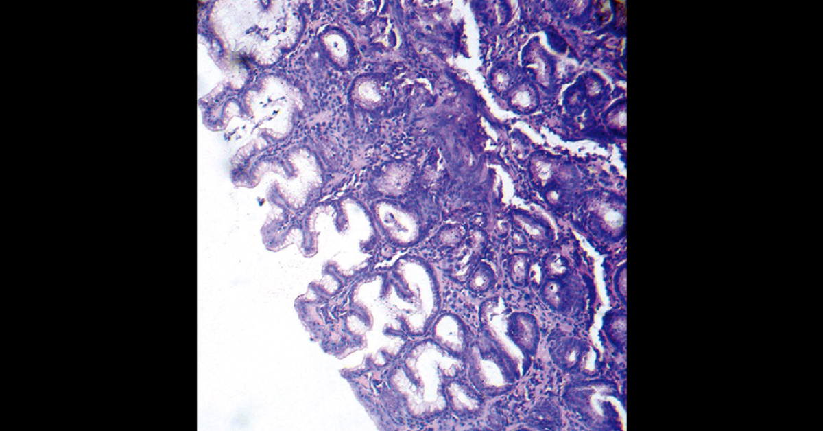Diagnosis For Epigastric Pain and Burning Sensation
