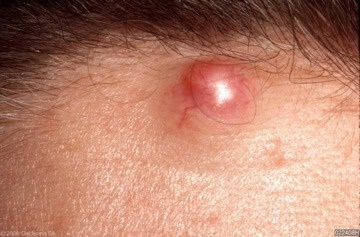 Identify The Dermal Condition