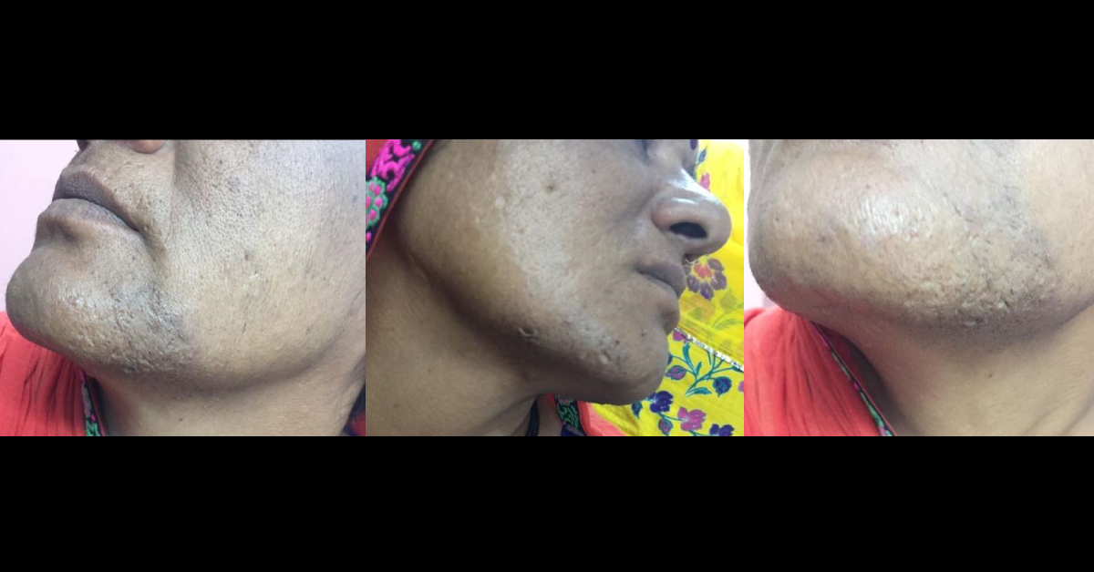 What Is This Skin Lesion On Face Of Woman