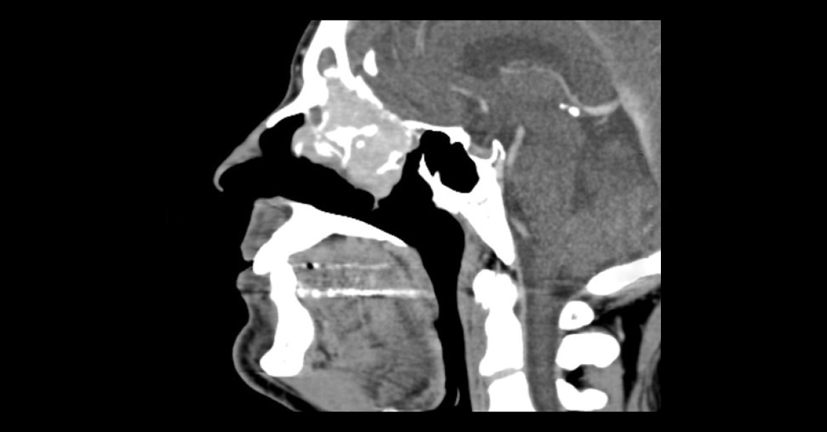 Irregular Mass In Nasal Cavity