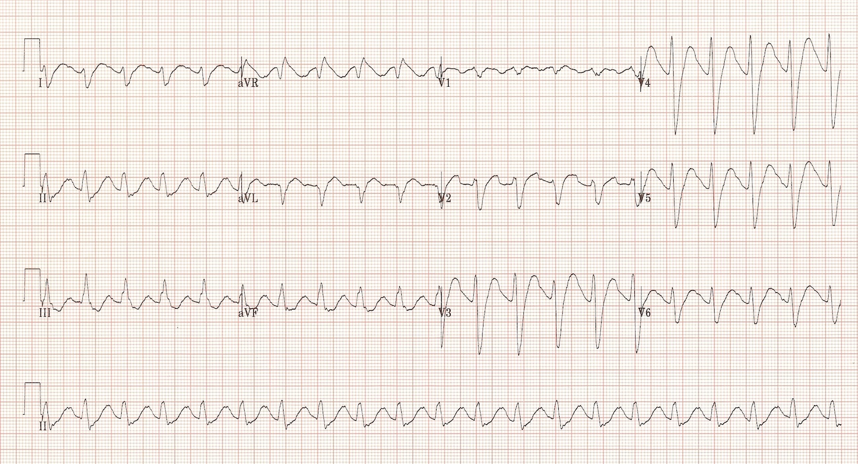 Interpret This ECG