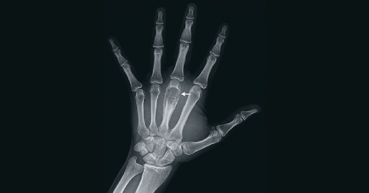 What Does This Child’s Hand Radiograph Indicate?