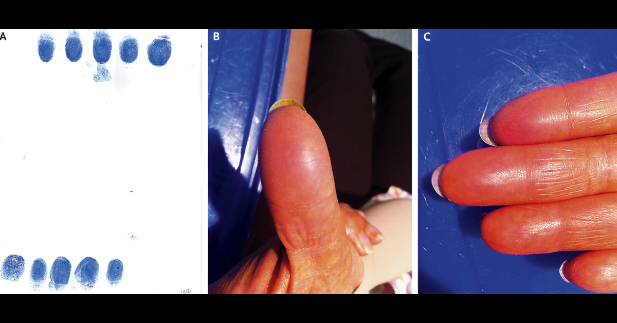 Determine The Reason For Loss Of Fingerprints