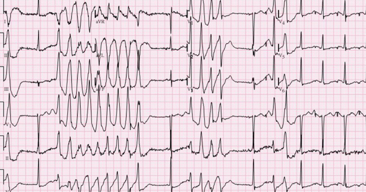 Interpret The ECG Findings