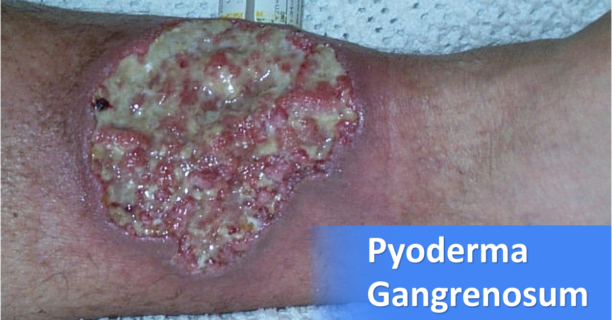 Recent Advances In Pyoderma Gangrenosum