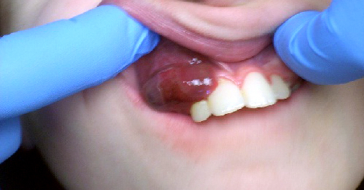 Intriguing Purple Mass On Teeth