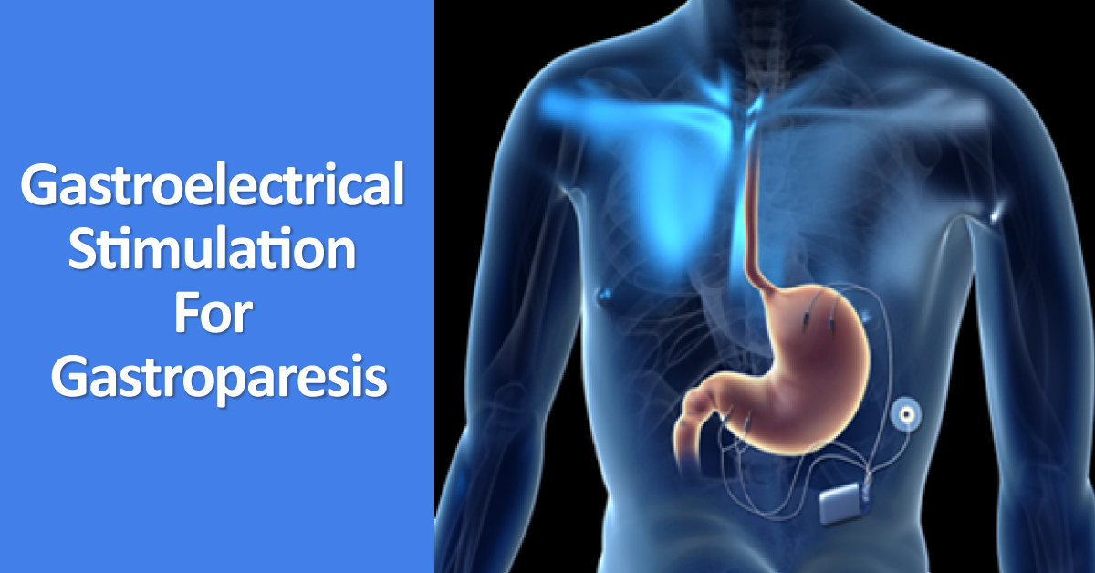 Gastroparesis: Gastroelectrical Stimulation Therapy Guidelines