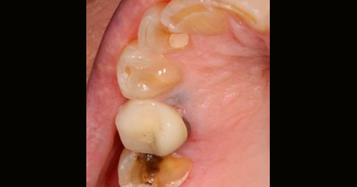 Blue Grey Macule