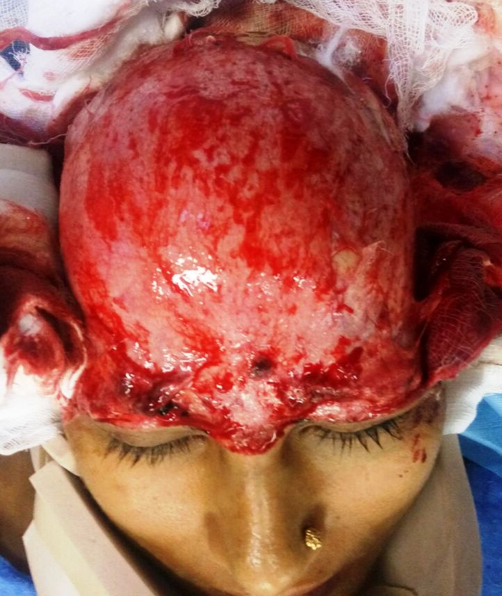 Replantation Of Total Scalp Avulsion: Rare Case, Good Outcome