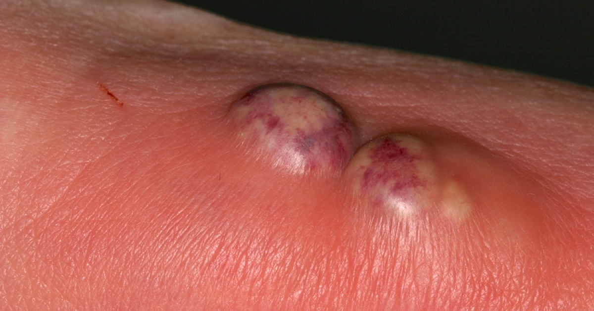 Management Of Skin Abscesses, Need For Standardization