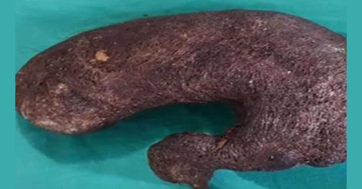 Big "Trichobezoar" Or Hair Ball In Young Girl's Stomach