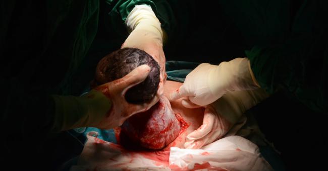 Is It Fair To Restrict Number Of Cesarean Section For A Doctor
