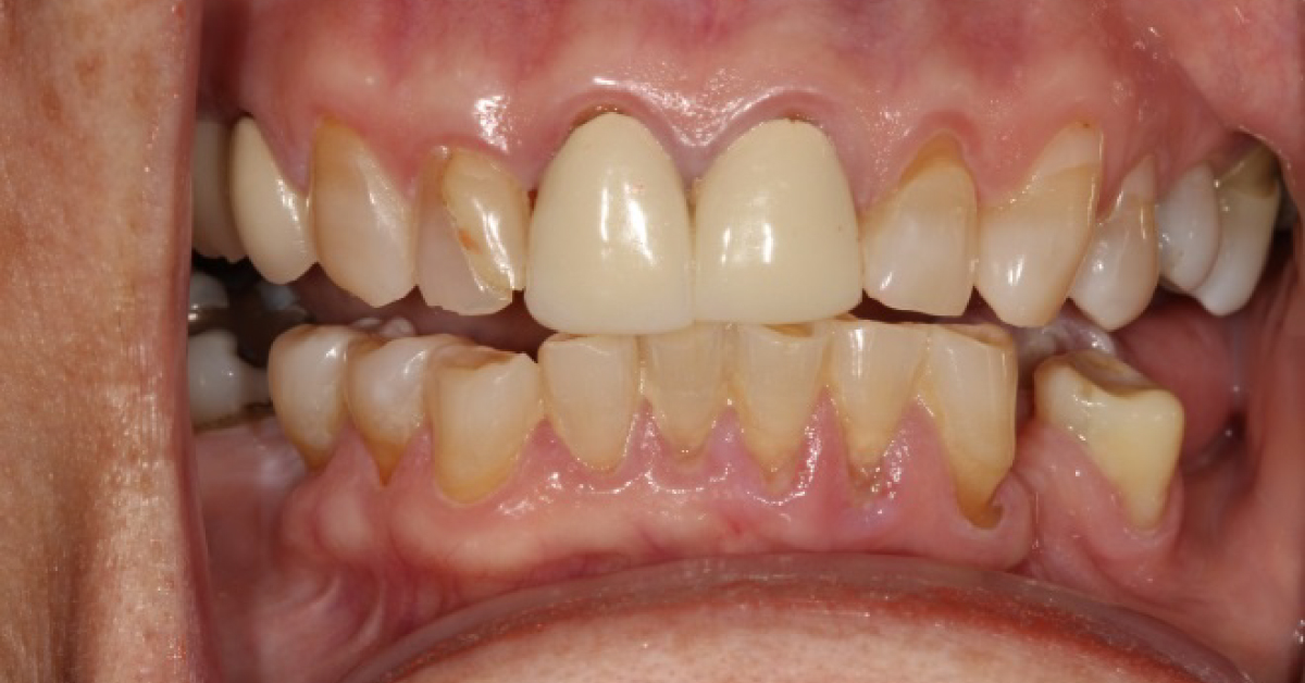 Case Of A Painful Bump in Floor of Mouth