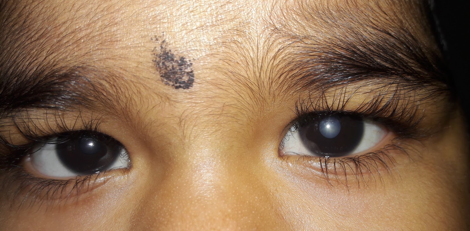 Nephrotic Syndrome With Cataract