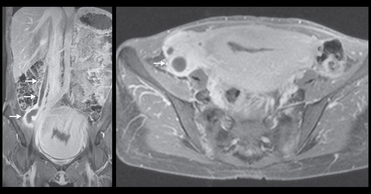 Identify This Condition In A Postpartum Woman