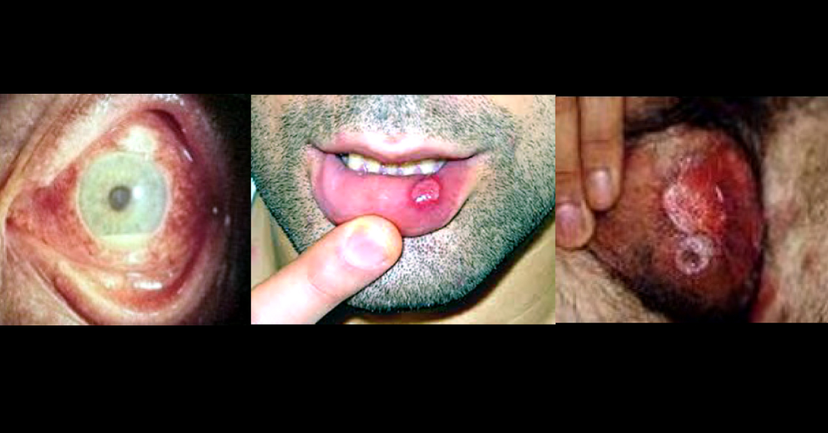 Pathophysiology Of The Behcets Disease
