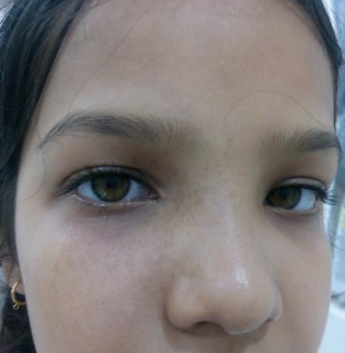 Diagnosis The Hyperpigmented Spots With Paresthesia