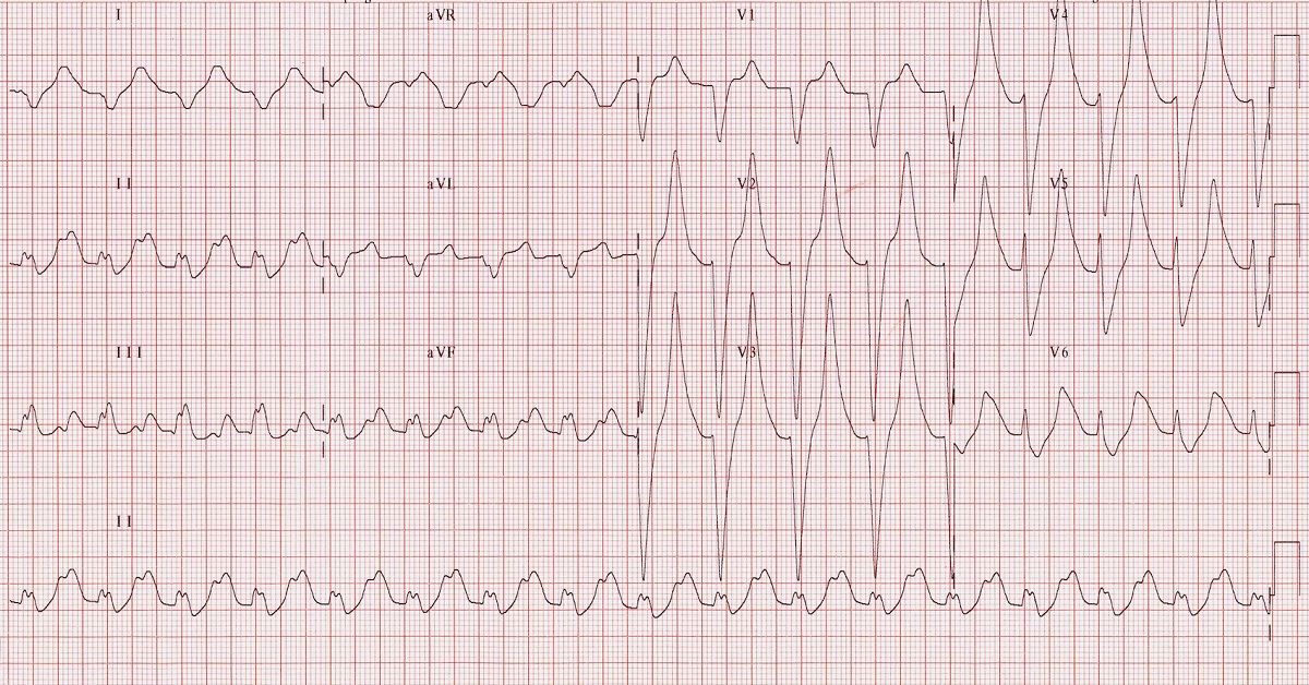 Drug That Induces Hyperkalemia