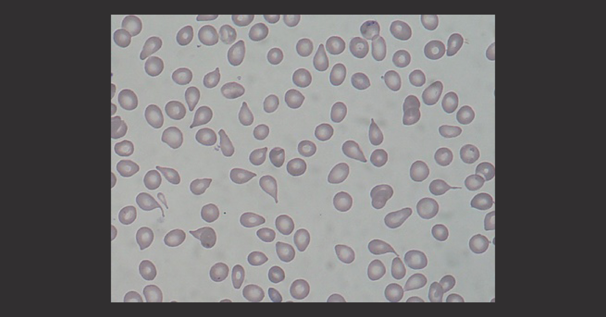 Solve This Hematological Case