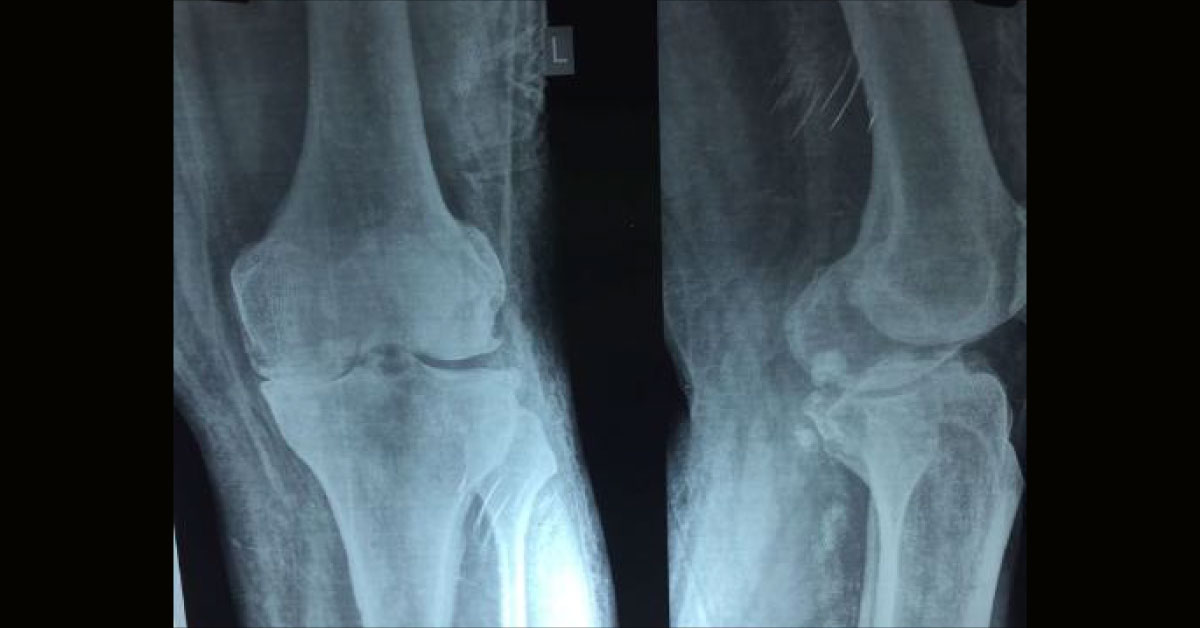 Asking For Treatment Of Knee, Other Than TKR