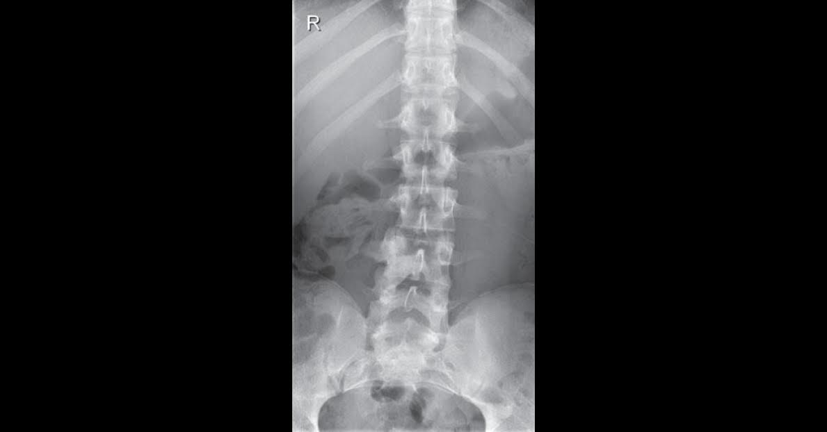 Back Pain Relieved Only By Aspirin, An Emergency Case