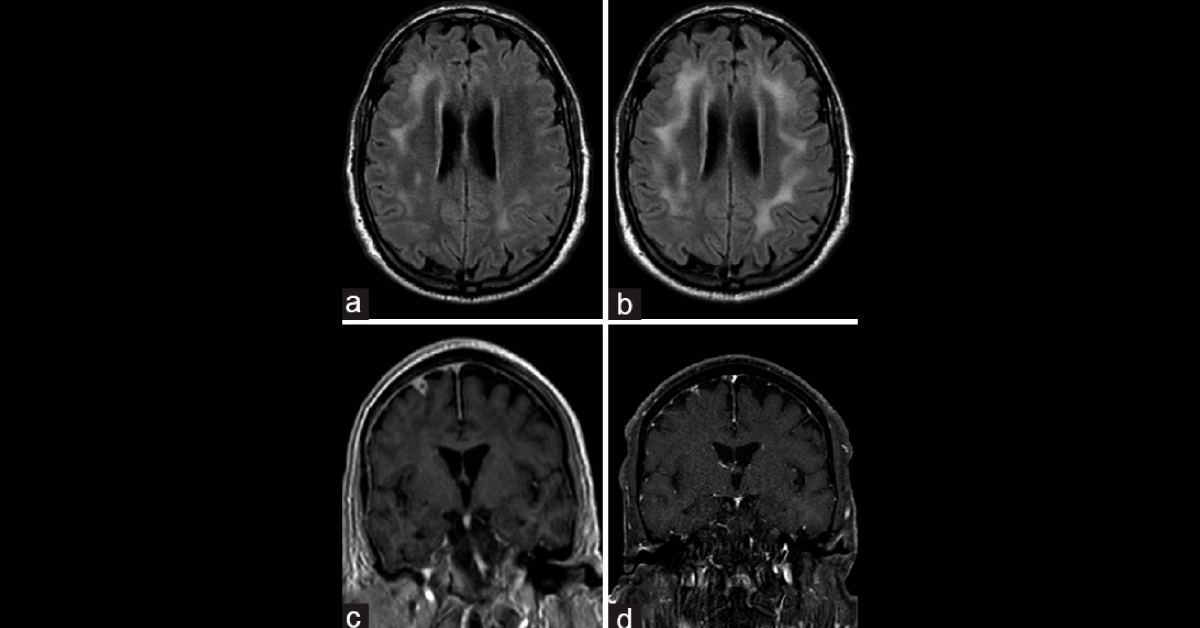 Solve This Neurology Case