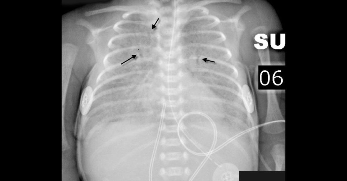 Spot The Respiratory Problem In This Newborn