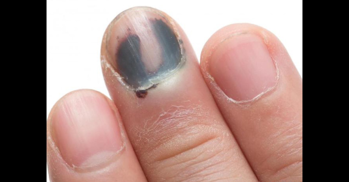 Haneke Diagnostic Technique For Subungual Pigmentation