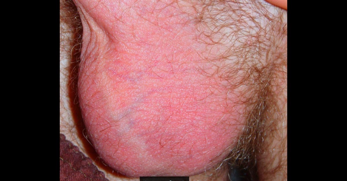 The Case Of Red Scrotum