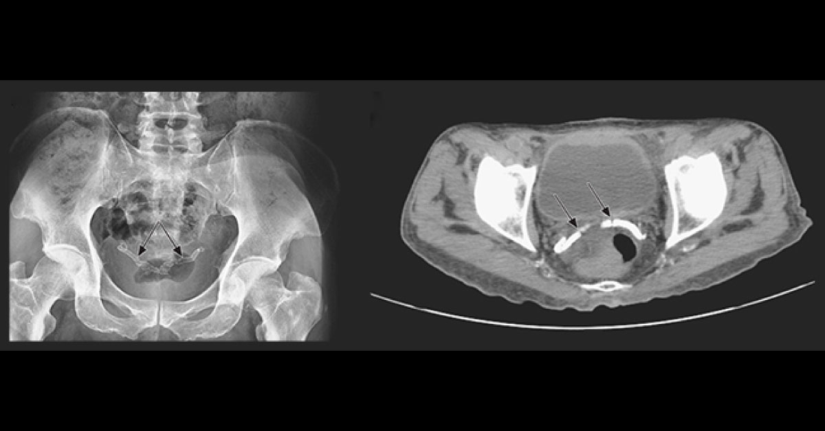 Diagnose This Condition In A Diabetic Man