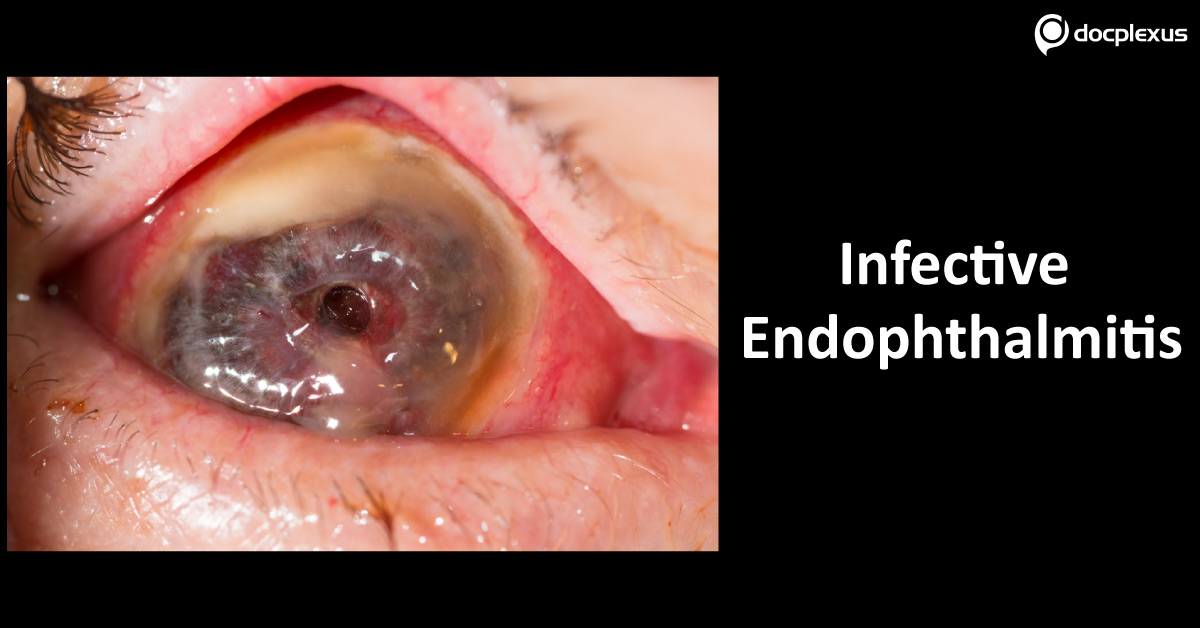 Infective Endophthalmitis, Treatment Protocol