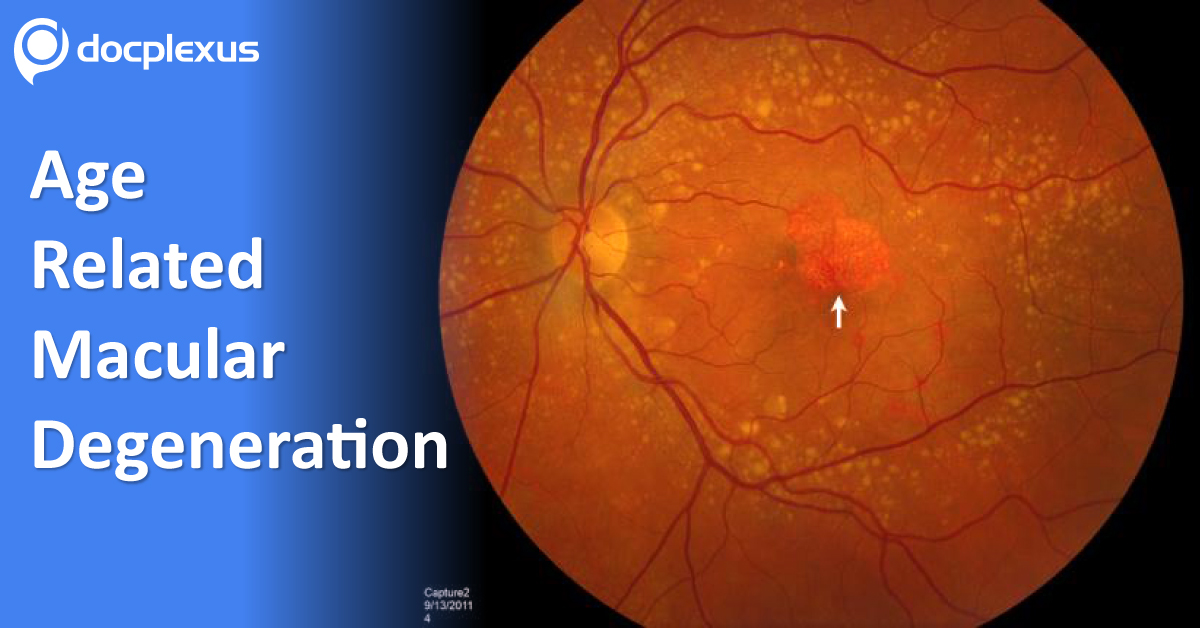 Long-Term VEGF Therapy For Age-Related Macular Degeneration