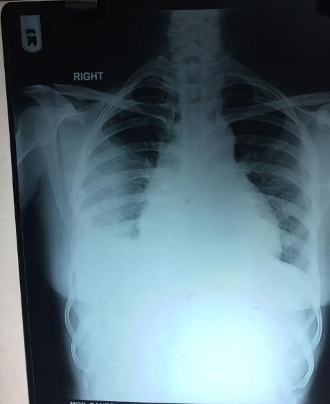 Is It Pericardial Pain Or Gastritis, Part 2