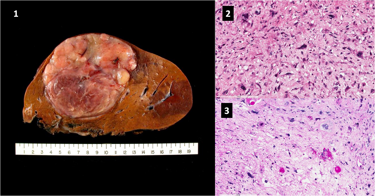 Solve This Rare Oncology Case
