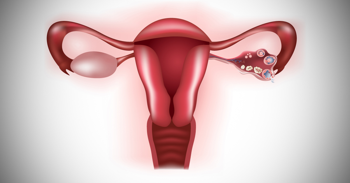 Premenopausal Women With Suspected Ovarian Masses: Management Guidelines