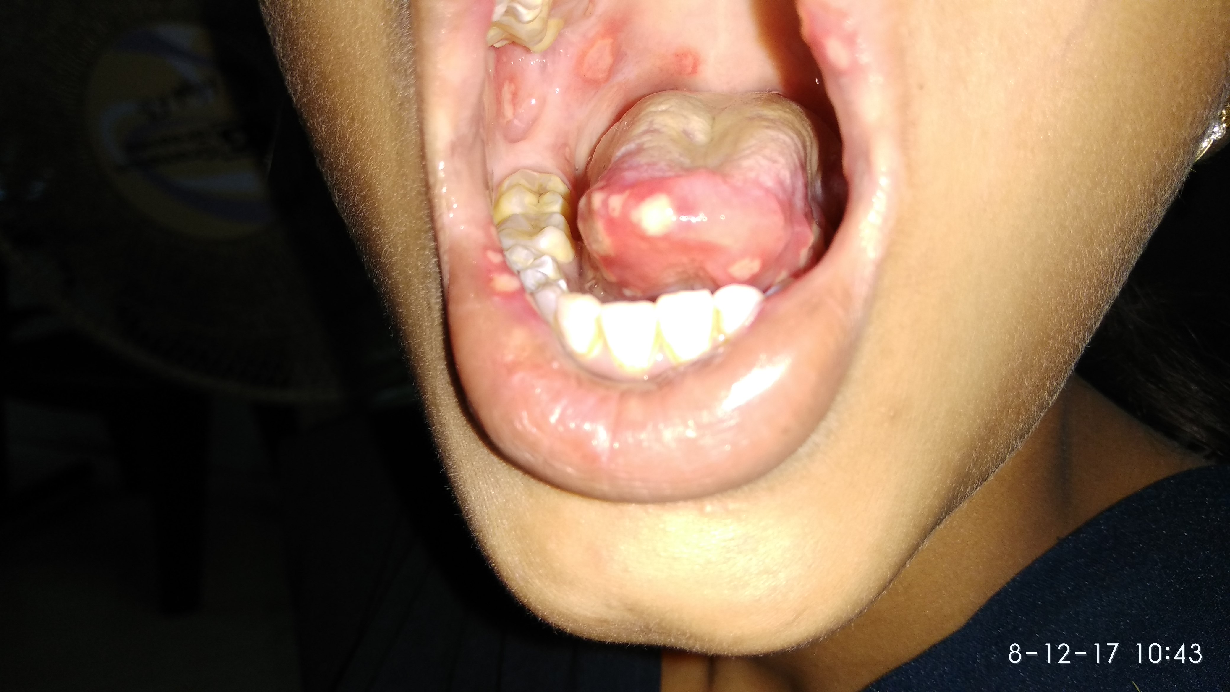 Recurrent Oral Ulcer
