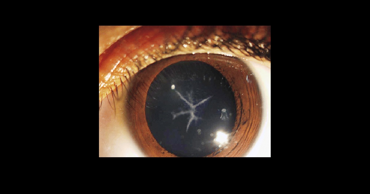 Identify This Condition In A Young Girl