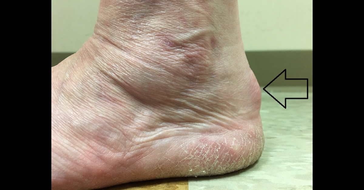 What Is This Bump On Back Of Heel?
