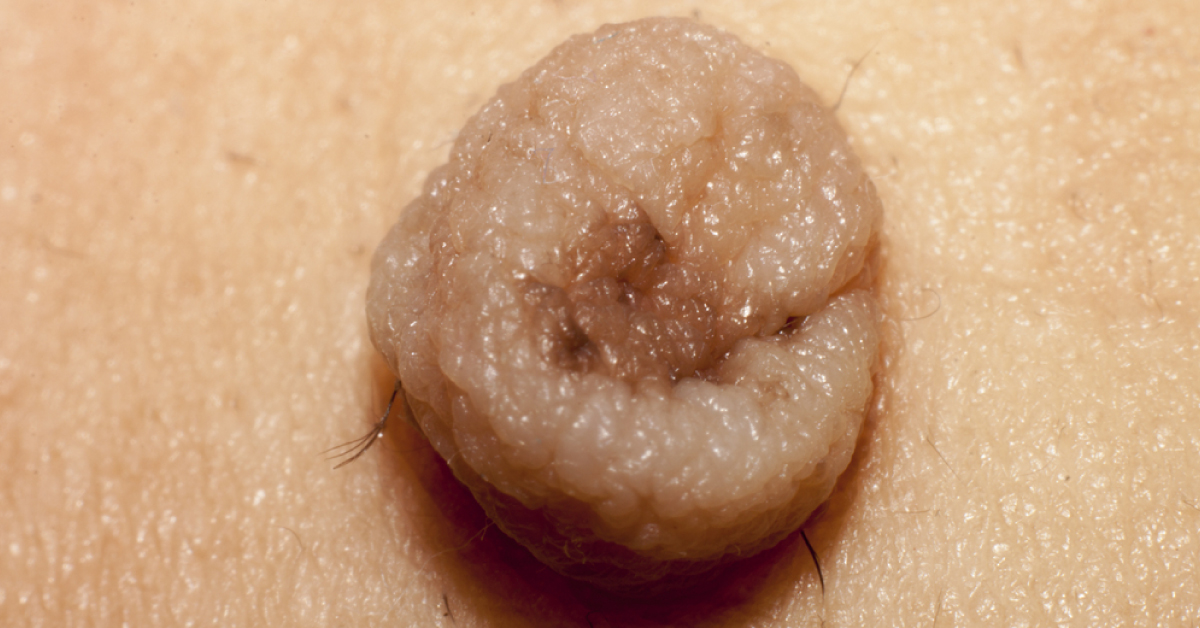 Non-Melanoma Skin Tumors: Photodynamic Therapy (PDT)