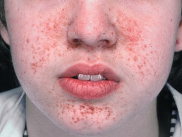 Resolve This Dermatological Case