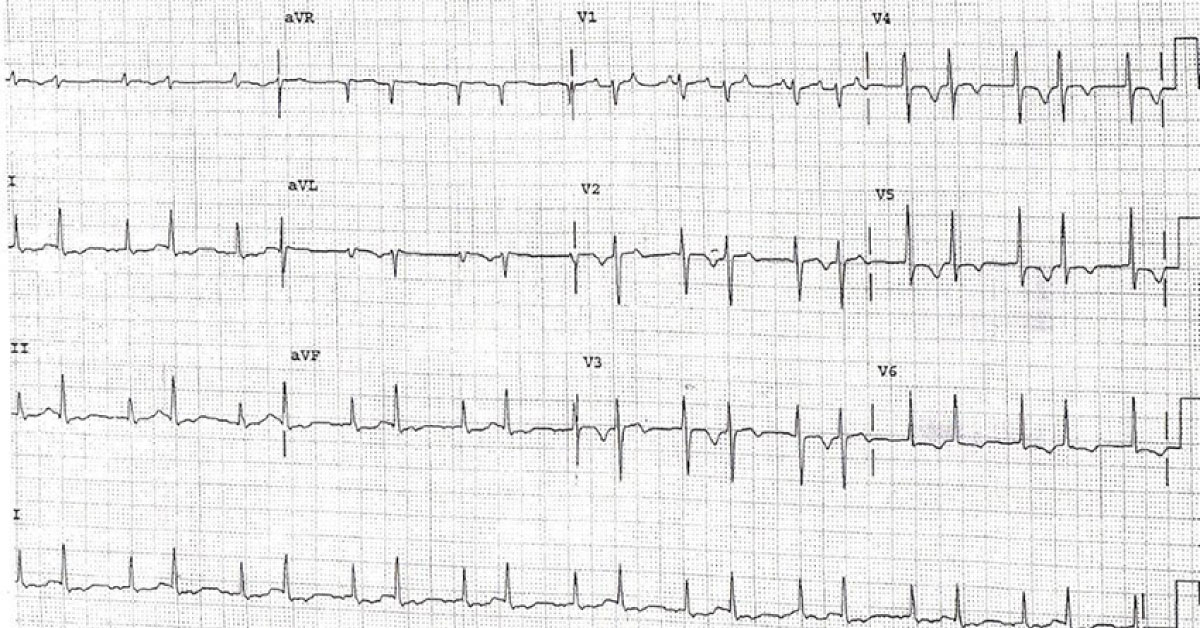 Diagnose This Hypertensive Crisis