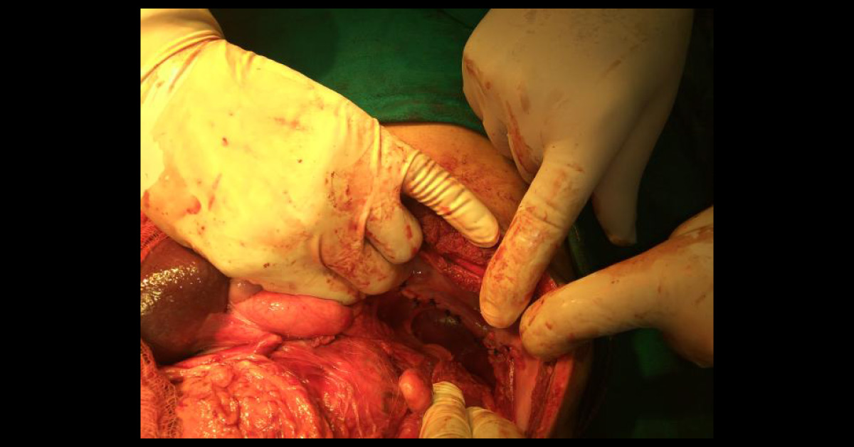 World Heaviest Tumor Of 70 Lbs Removed From 40 Years Old Woman's Uterus