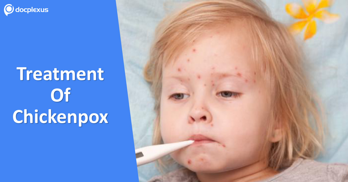 Treatment Of Pediatric Chickenpox