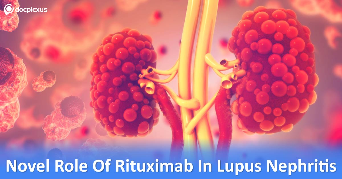 Childhood Lupus Nephritis: Combination Therapy Of Rituximab And Mycophenolate Mofetil