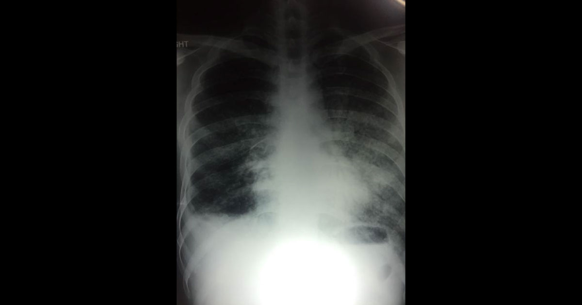Is This Pneumoconiasis/Tuberculosis?